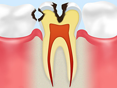 3.象牙質のむし歯（C2）
