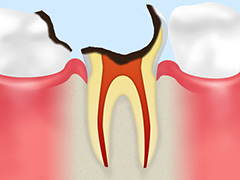 5.歯の根っこだけ残ったむし歯（C4）