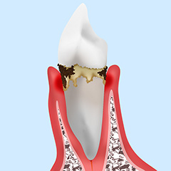 2.軽度の歯周炎