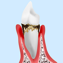 3.中等度の歯周炎
