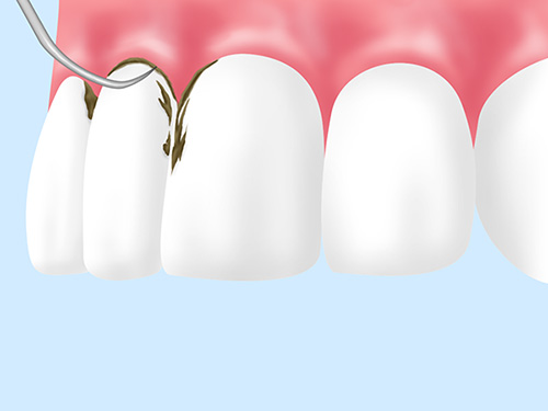 当院の歯周病治療